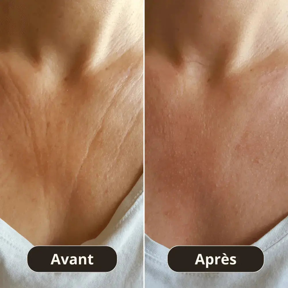 Patch Anti-Rides Décolleté Montainoir