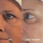 Micro-infusion Anti-Âge Montainoir — Revival Infusion System