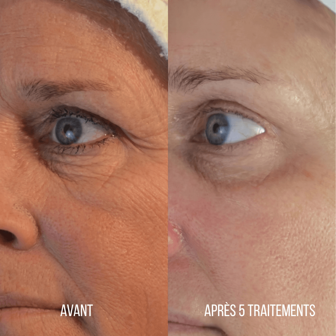 Micro-infusion Anti-Âge Montainoir — Revival Infusion System