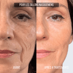 Micro-infusion Anti-Âge Montainoir — Revival Infusion System