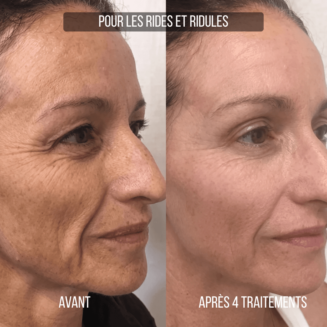 Micro-infusion Anti-Âge Montainoir — Revival Infusion System