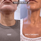 Micro-infusion Anti-Âge Montainoir — Revival Infusion System