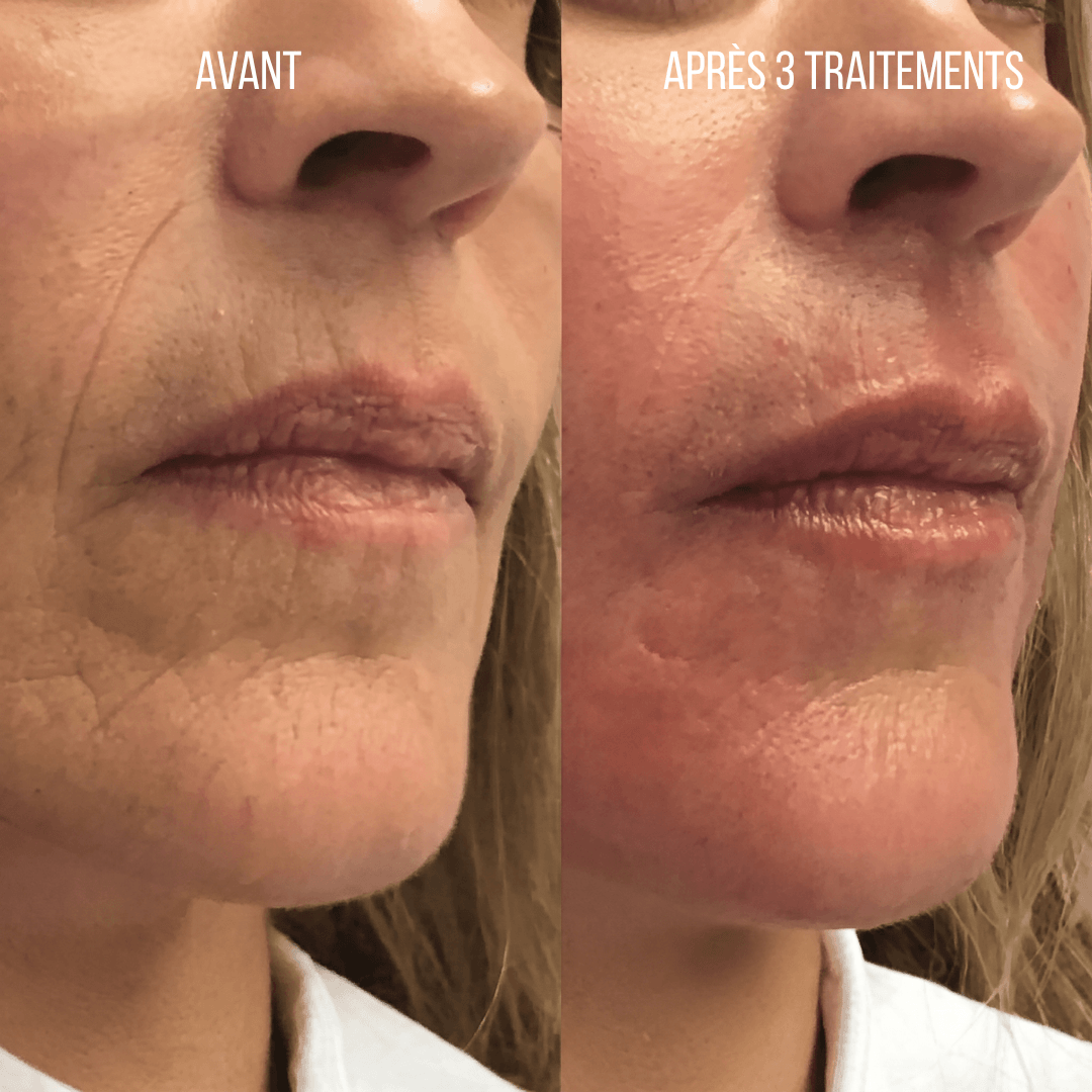 Micro-infusion Anti-Âge Montainoir — Revival Infusion System